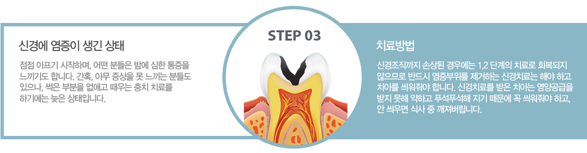 3�ܰ� : �Ű濡 ������ ���� ���� ? ���� ������ �����ϸ�, � �е��� �㿡 ���� ������ �����⵵ �մϴ�. ��Ȥ, �ƹ� ������ �� ������ �е鵵 ������, ���� �κ��� ���ְ� ����� ��ġ ġ�Ḧ �ϱ⿡�� ���� �����Դϴ�.
		ġ����
		3�ܰ� : �Ű��������� �ջ�� ��쿡�� 1,2 �ܰ��� ġ��� ȸ������ �����Ƿ� �ݵ�� ���������� �����ϴ� �Ű�ġ��� �ؾ� �ϰ� ġ�Ƹ� ������� �մϴ�. �Ű�ġ�Ḧ ���� ġ�ƴ� ��������� ���� ���� ���ϰ� Ǫ��Ǫ���� ���� ������ �� ������� �ϰ�, �� ����� �Ļ� �� ���������ϴ�.