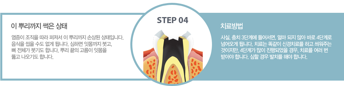 4�ܰ� : �� �Ѹ����� ���� ���� ? ������ ������ ���� ������ �� �Ѹ����� �ջ�� �����Դϴ�. ������ ���� ���� ���� �˴ϴ�. ���ϸ� �ո����� �װ�, �� ��ü�� �ױ⵵ �մϴ�. �Ѹ� ���� ������ �ո��� �հ� �����⵵ �մϴ�.
		4�ܰ� : ���, ��ġ 3�ܰ迡 ����, �� ���� �ʾ� �ٷ� 4�ܰ�� �Ѿ���� �˴ϴ�. ġ��� �Ȱ��� �Ű�ġ�Ḧ �ϰ� �����ִ� ��������, 4�ܰ谡 ���� ����Ǿ��� ���, ġ�Ḧ ���� �� �޾ƾ� �մϴ�. ���� ��� ��ġ�� �ؾ� �մϴ�.